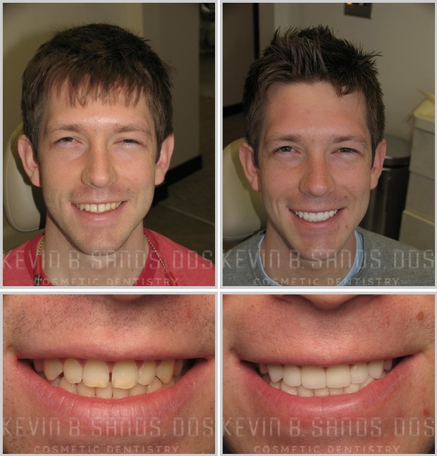 Porcelain Dental Veneers Beverly Hills Los Angeles CA