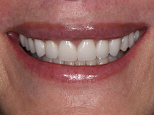 patient 12 after