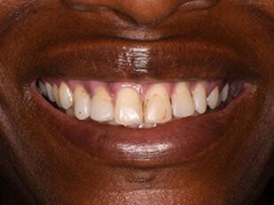patient 13 before