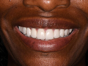 patient 13 after
