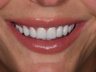 patient 11 after