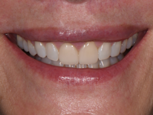 patient 13 before