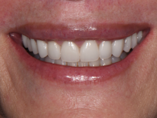 patient 13 after