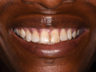 patient 14 before